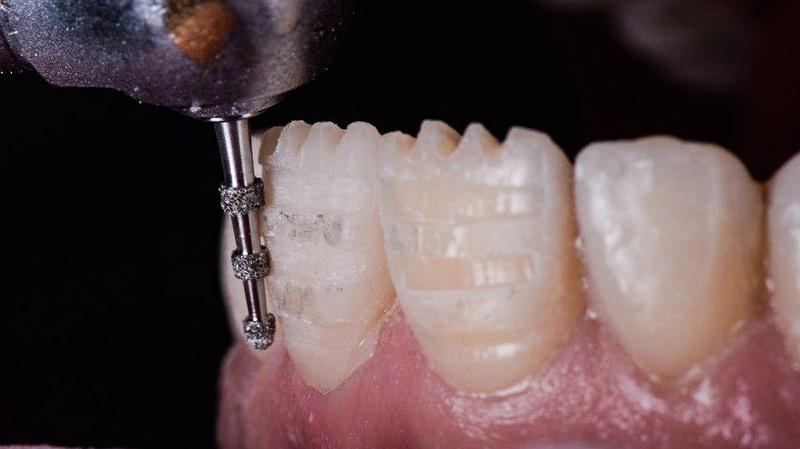 Xâm lấn quá nhiều vào cấu trúc răng thật ảnh hưởng đến tuổi thọ của răng