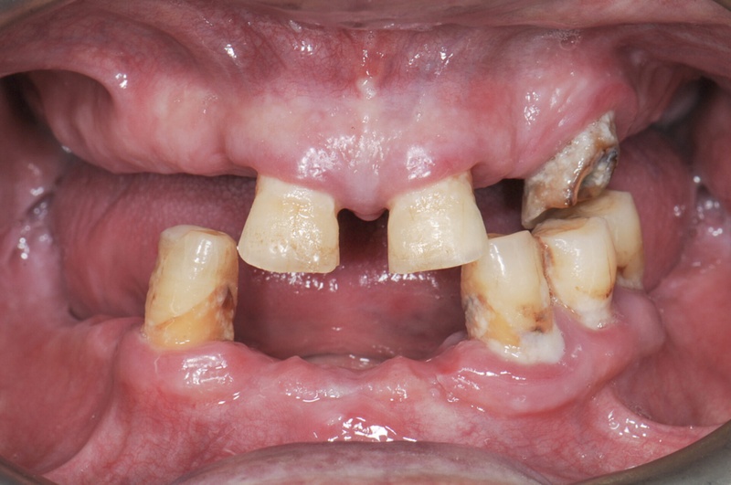 Bệnh nhân mắc bệnh lý viêm nha chu cần điều trị triệt để trước khi cấy Implant