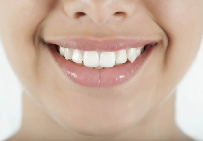 Ưu điểm của phương pháp bọc răng sứ khểnh