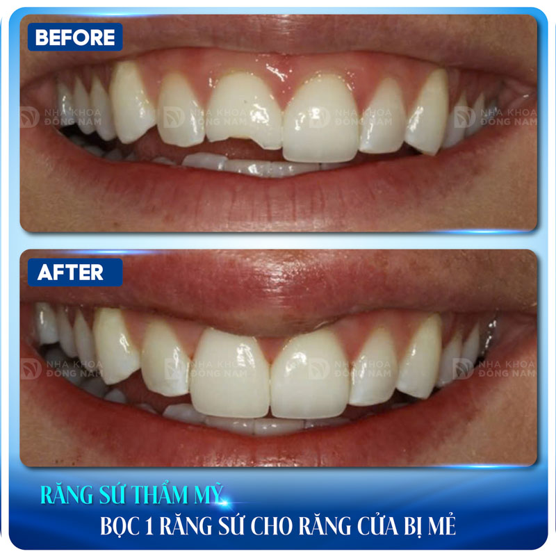 bọc răng sứ thẩm mỹ bọc 1 răng sứ cho răng cửa bị mẻ