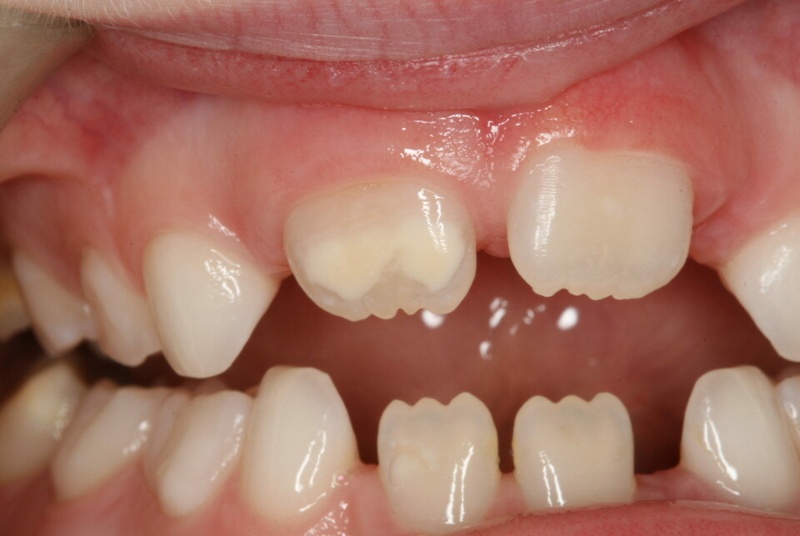 Các khoảng răng thưa lớn hơn bình thường khi bệnh nhân thiếu răng bẩm sinh