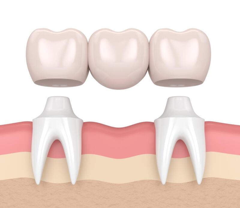 Phương pháp cầu răng sứ không mang lại cảm giác đau vì có tiêm thuốc tê