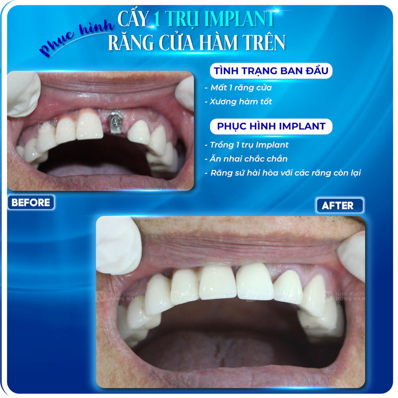 cấy 1 trụ implant răng cửa hàm trên