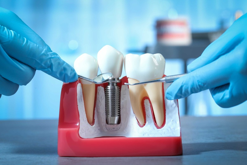 Cấy ghép Implant là phương pháp trồng răng giả tốt nhất được khuyên dùng