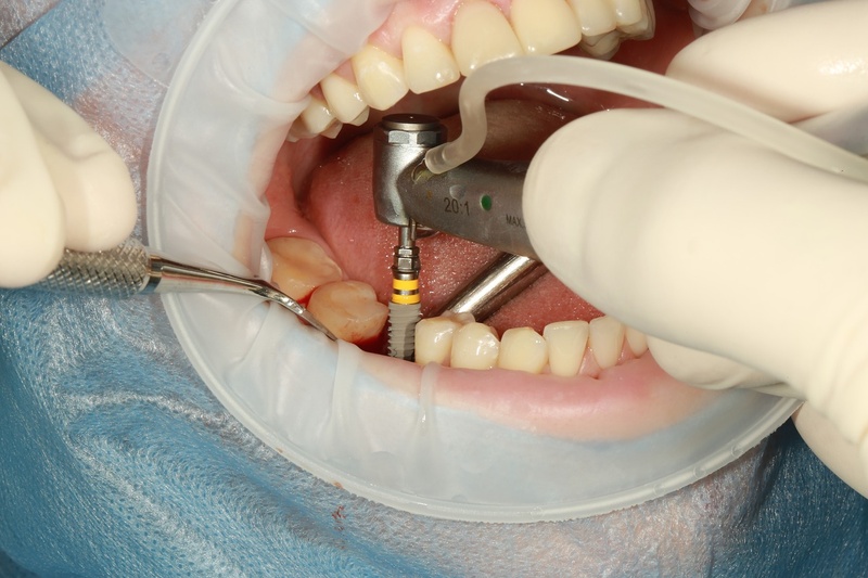 Cấy Implant ở trường hợp mất răng cải thiện xô lệch
