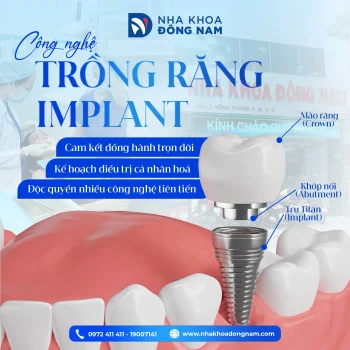 cong nghe trong rang implant bs dung