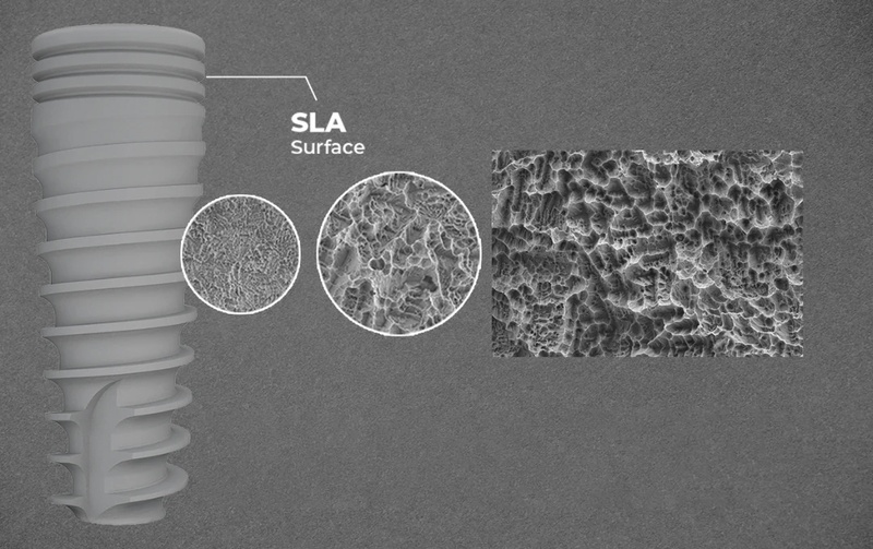 Điểm khác biệt của các dòng trụ Implant Mỹ