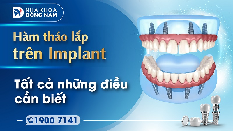 Hàm tháo lắp trên Implant