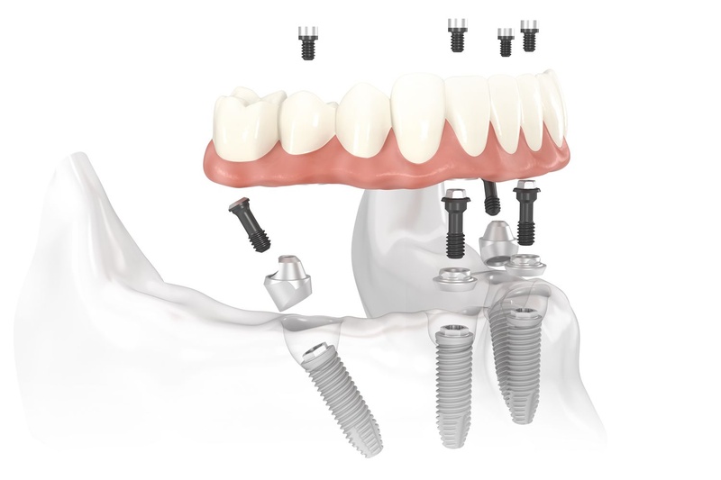 Implant Multi áp dụng cho bệnh nhân mất răng toàn hàm