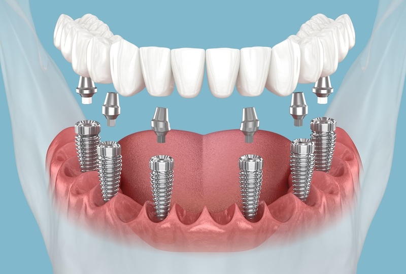 Kỹ thuật trồng răng Implant All-on-6