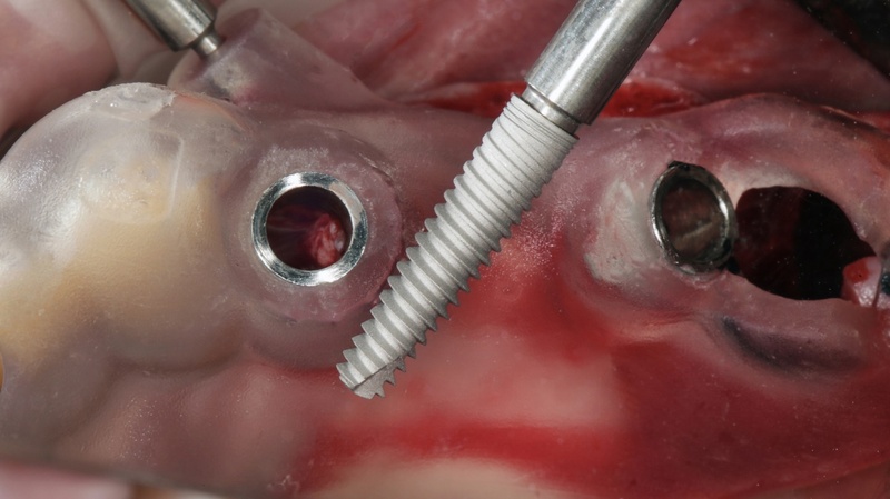 Liên hệ bác sĩ khi trụ Implant gặp vấn đề bất thường