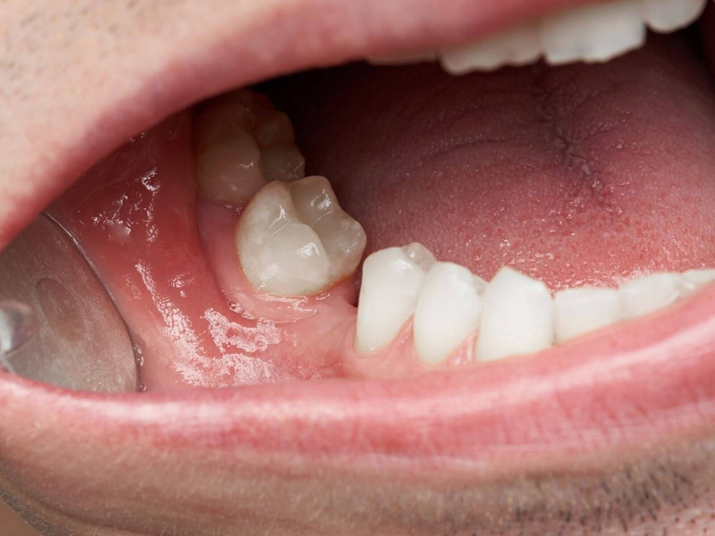 Mất răng lâu năm không trồng lại làm răng bị nghiêng