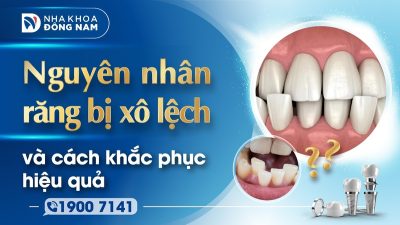 Nguyên nhân răng bị xô lệch và cách khắc phục hiệu quả