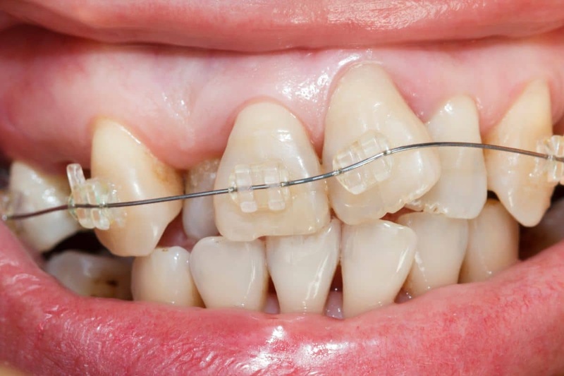 Niềng răng thưa sớm giải quyết tình trạng răng nghiêng