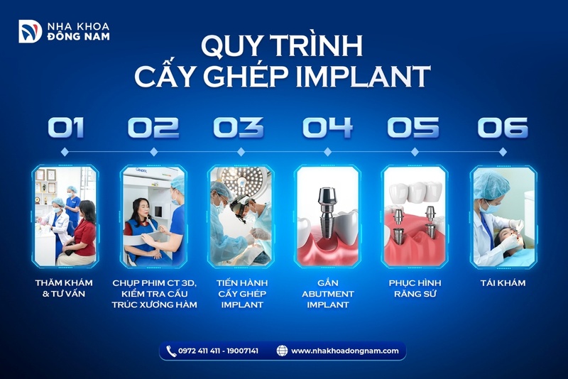 Quy trình cấy ghép Implant chuẩn y khoa