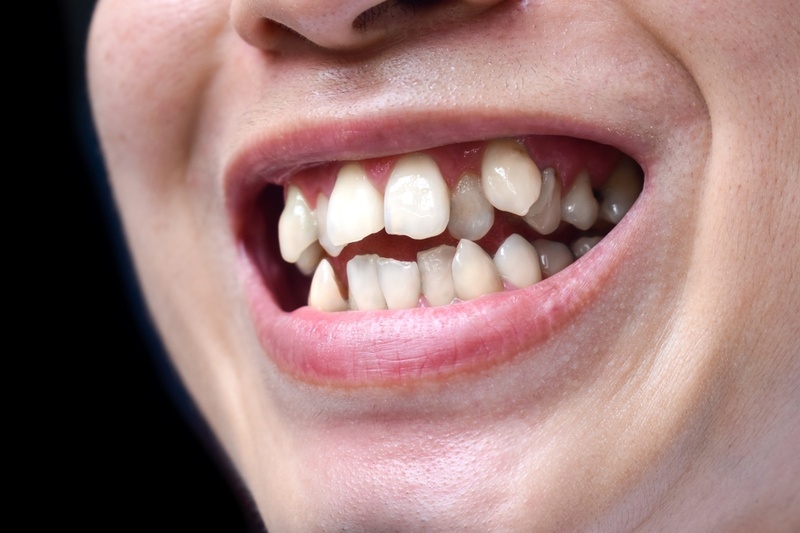 Răng chuyển vị là hiện tượng các răng chuyển vị trí cho nhau