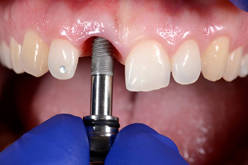 Răng Implant áp dụng cho mọi trường hợp thiếu răng bẩm sinh