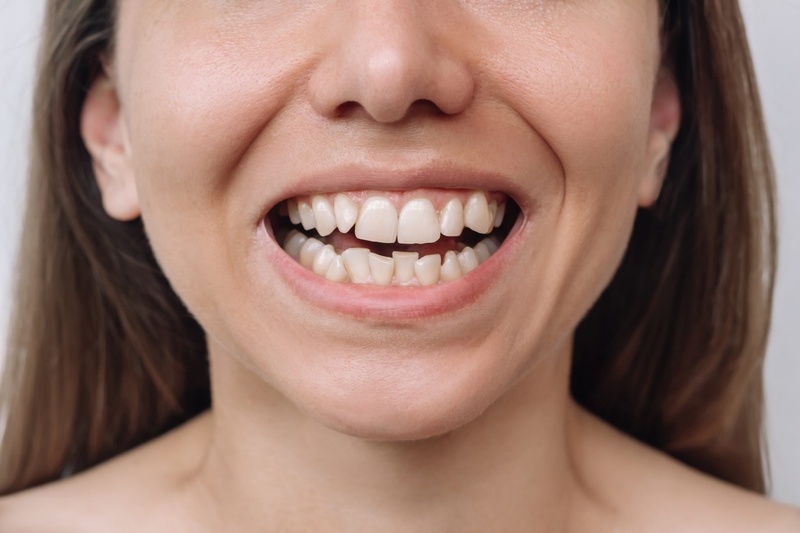 Răng nghiêng gây mất thẩm mỹ ảnh hưởng tâm lý