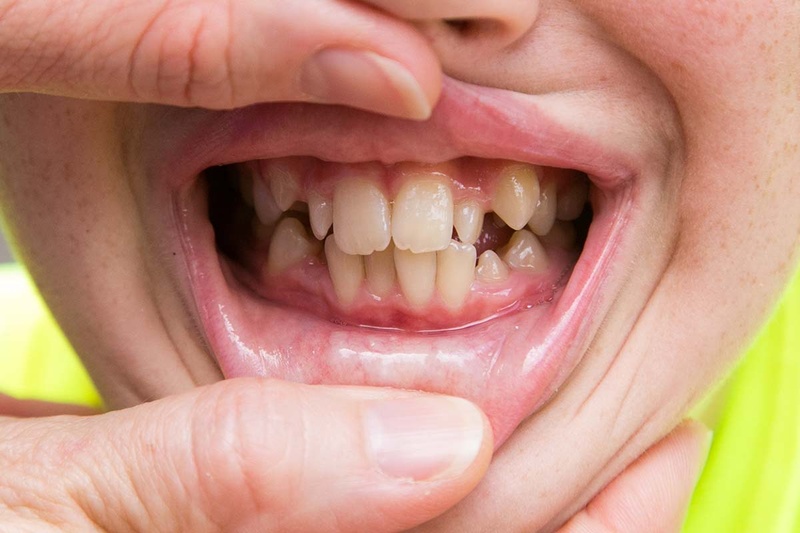 Răng nghiêng gây thưa răng, tạo kẽ hở