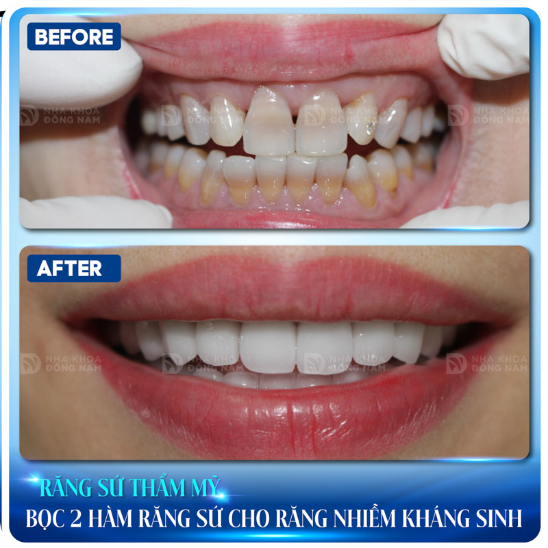 răng sứ thẩm mỹ bọc 2 hàm răng sứ cho răng nhiễm kháng sinh