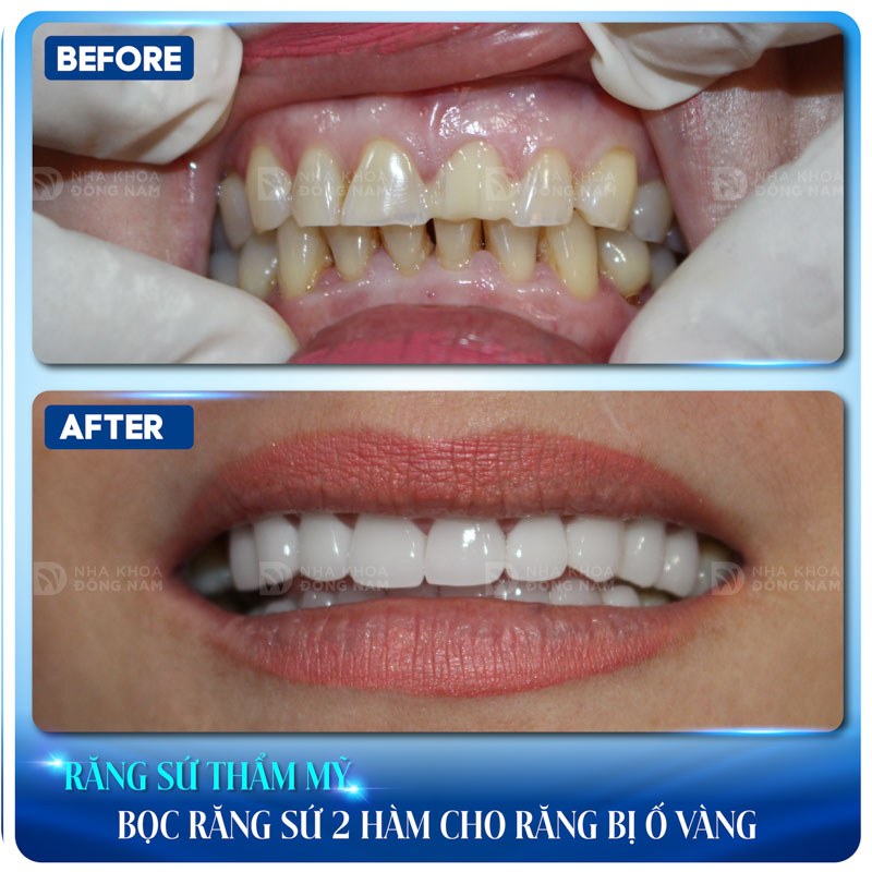 răng sứ thẩm mỹ bọc răng sứ 2 hàm cho răng bị ố vàng