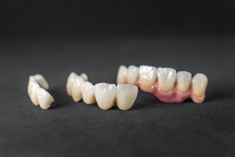 Mão răng tạm trên Implant