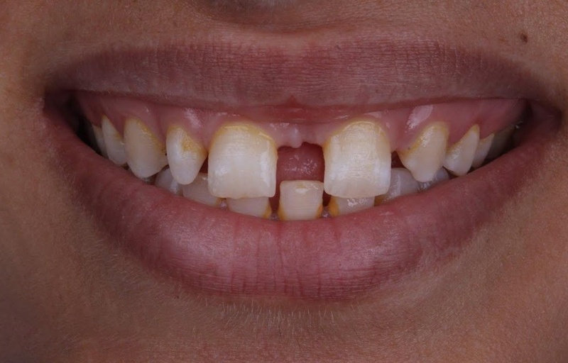 Thẩm mỹ nụ cười bị ảnh hưởng do thiếu răng bẩm sinh
