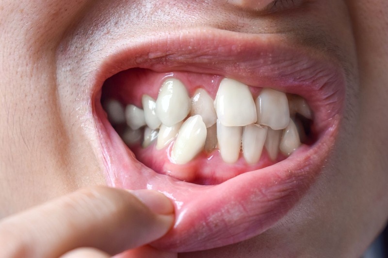 Tình trạng răng bị nghiêng, cụp và lệch gây cản trở chức năng răng