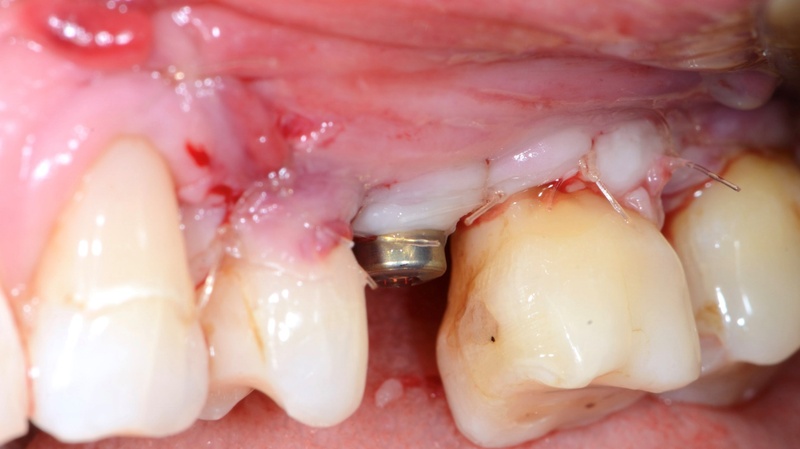 Tình trạng viêm quanh Implant