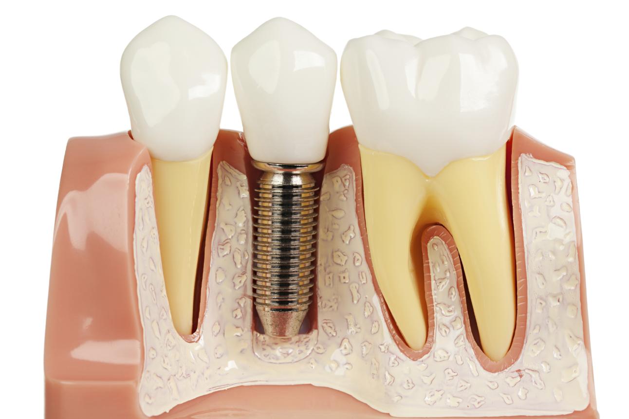 Trồng răng Implant Mỹ giúp ngăn ngừa tiêu xương hàm