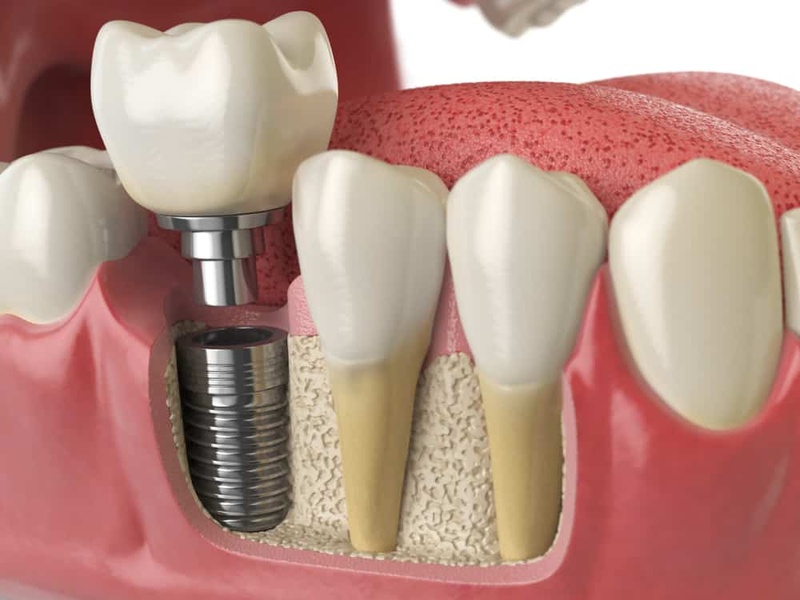 Trồng răng Implant Mỹ giúp ngăn ngừa tiêu xương hàm