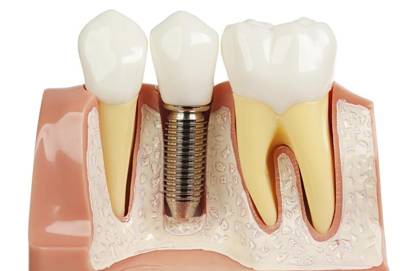 Phương pháp trồng răng Implant sẽ mang lại cảm giác khó chịu nhẹ khi thuốc tê hết tác dụng