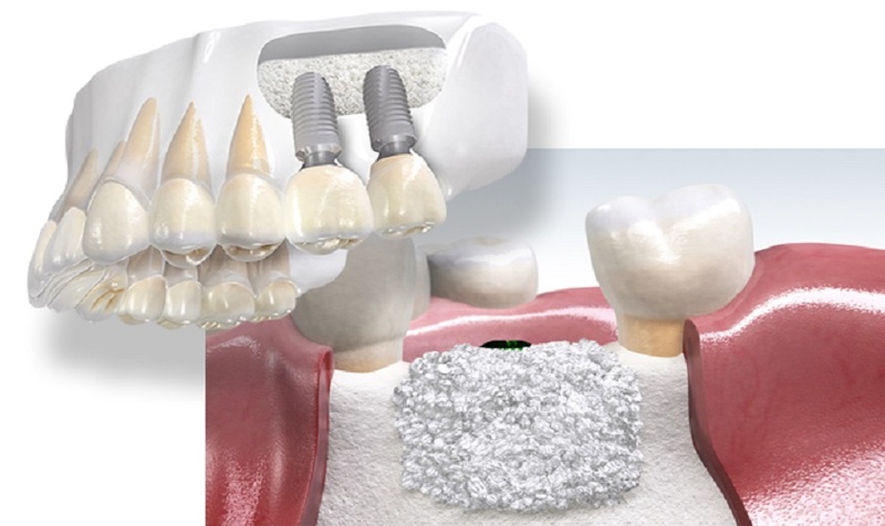 Trường hợp nâng xoang, ghép xương cần nghỉ ngơi