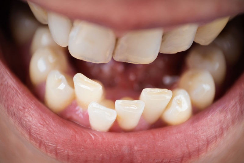 Trường hợp răng hàm không tương xứng làm răng không đủ chỗ mọc lên