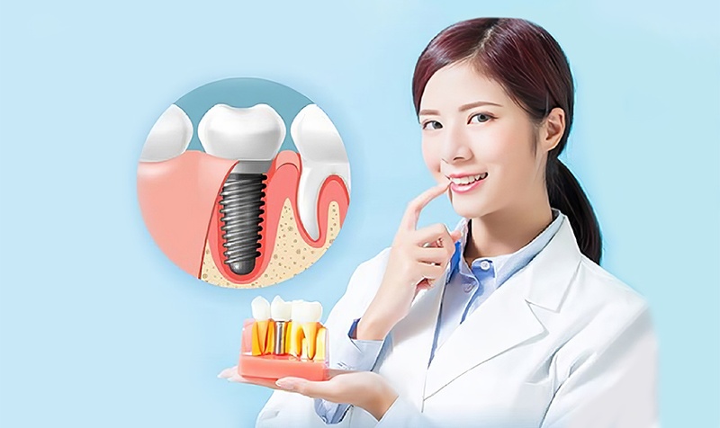 Tuân thủ các cách chăm sóc răng Implant sau điều trị để chuyến bay diễn ra suôn sẻ