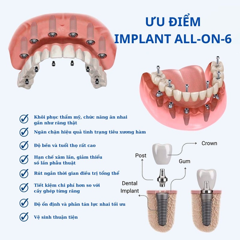 Ưu điểm của phương pháp cấy ghép Implant Al-on-6