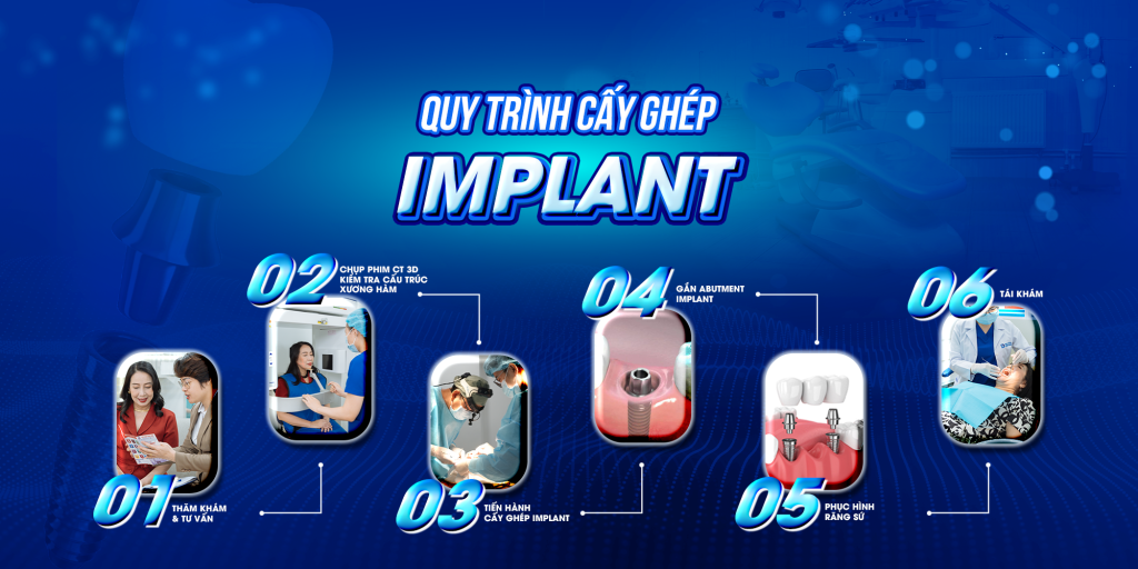 Quy trình cấy ghép Implant