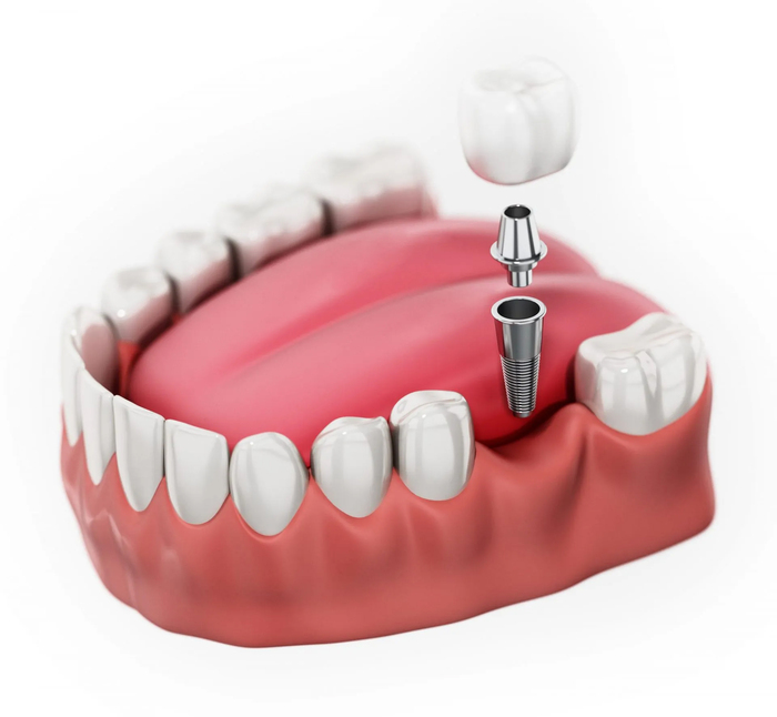 Trụ Implant C-Tech phù hợp với người mất 1 răng