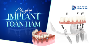 cấy ghép Implant toàn hàm