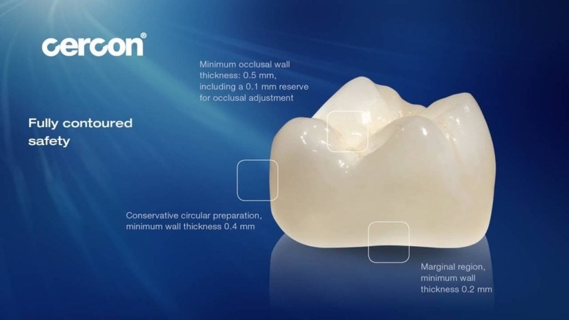 Cercon là dòng răng toàn sứ cao cấp phổ biến hiện nay