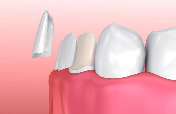Gắn mặt sứ Veneer lên răng