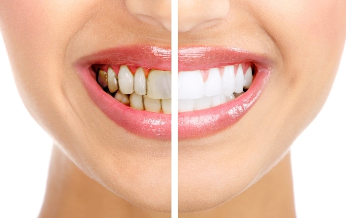 Dán sứ Veneer đem đến vẻ đẹp tự nhiên