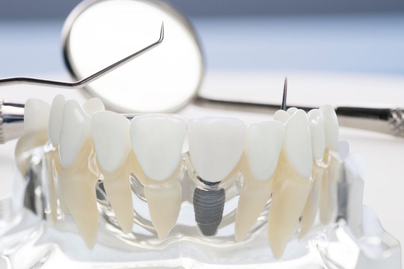 Đối tượng phù hợp cấy ghép Implant
