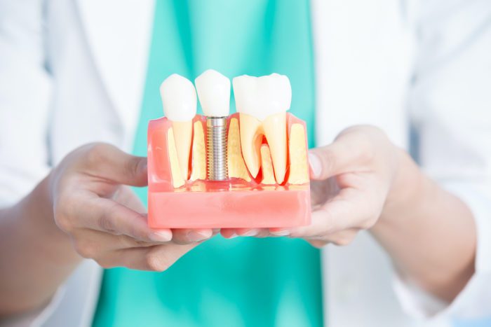 Dòng Implant Hiossen có mức giá tầm trung