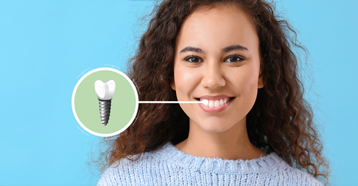 Implant Hiossen có thể cấy ghép đa dạng vị trí