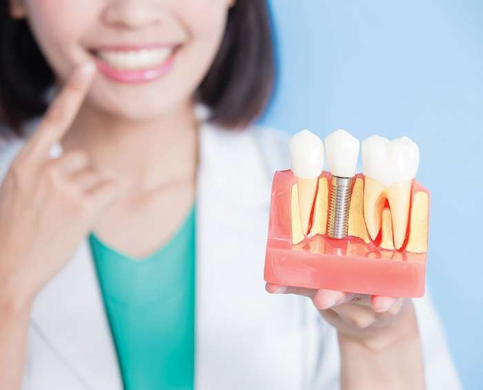 Trụ Implant Neodent phù hợp với hầu hết các trường hợp phục hình răng