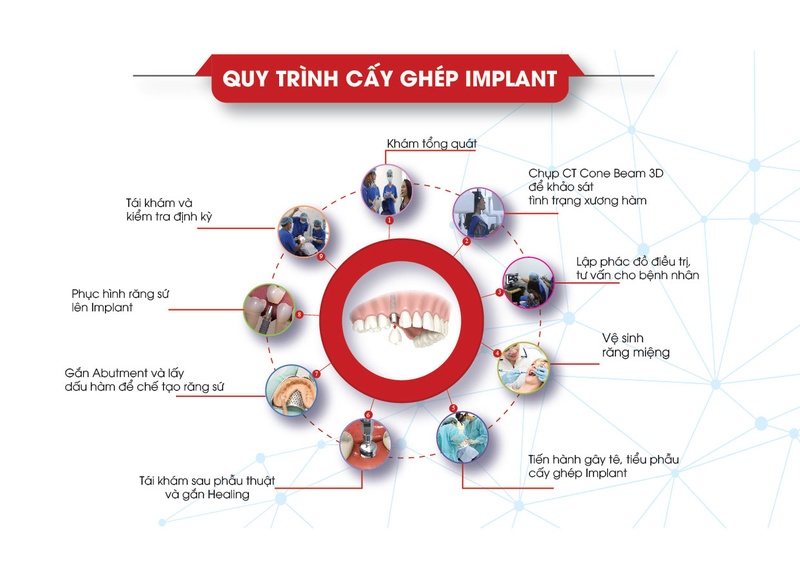 Quy trình cấy ghép Implant tại Nha Khoa Đông Nam