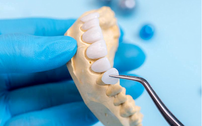 Quy trình chế tác răng sứ Orodent được ứng dụng công nghệ tiên tiến và kỹ thuật hiện đại