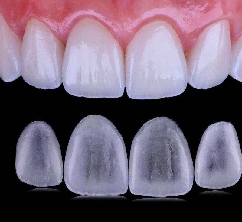 Răng sứ Cercon HT giúp bảo tồn răng gốc tối đa