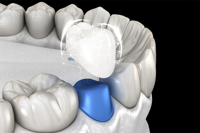 Răng sứ Orodent đến từ Ý